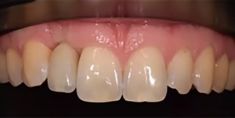 Zubní implantáty - Náhrada chybějícího zubu pomocí zubního implantátu, stav před a po. 
Archiv: RB dent   Liberec - MUDr. Richard Benko