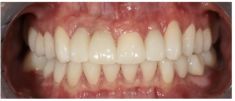 Zubní implantáty - 3D plánovaní. Zhotovení chirurgické šablony. Extrakce zubů 12,11,22 zavedení implantátů. Provizorní můstek. Kostní plastika a plastika dásní. 3D modelace. Zhotovení a fixace zirkonových korunek a keramických fazet.