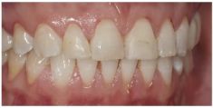 BioDent-tur s.r.o. - Keramické fazety BLEACH CEREC na počkaní.