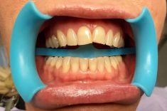 Bělení zubů - Před bělením a po bělení zubů.