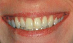 Bělení zubů - fotka před - Esthesia - klinika rodinného zdraví a krásy - STOMATOLOGIE