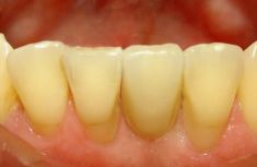 Zubní implantáty - fotka před - Privátní zubní ordinace