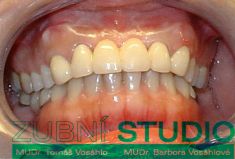 Keramické korunky a můstky - fotka před - Privátní zubní ordinace