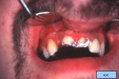 Zubní implantáty - fotka před - Centrum estetické stomatologie ARIES s.r.o.