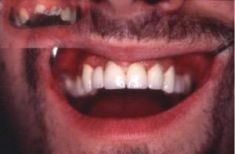 Zubní implantáty - fotka před - Centrum estetické stomatologie ARIES s.r.o.