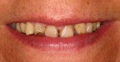 Zubní implantáty - fotka před - MUDr. Radek Mounajjed, D.D.S., Ph.D.