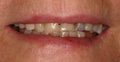 Zubní implantáty - fotka před - MUDr. Radek Mounajjed, D.D.S., Ph.D.