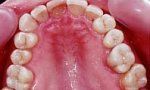 Zubní výplně (záchovná stomatologie) - fotka před - M-DENT - Privátní zubní ordinace doktora Majera