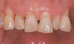 Keramické fazety - fotka před - M-DENT - Privátní zubní ordinace doktora Majera