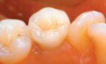 Keramické korunky a můstky - fotka před - M-DENT - Privátní zubní ordinace doktora Majera