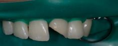 Zubní výplně (záchovná stomatologie) - fotka před - MUDr. Martin Kittler