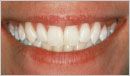 Bělení zubů - fotka před - MUDr. Dana Smolíková