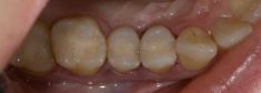 Zubní výplně (záchovná stomatologie) - fotka před