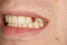 Zubní implantáty - fotka před - MUDr.  Kamil Beneš