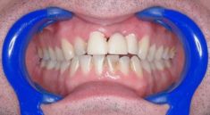 Dentální hygiena - fotka před - Dental Office H33