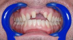 Keramické korunky a můstky - fotka před - Dental Office H33