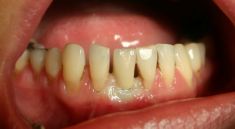 Zubní implantáty - fotka před - Dental Office H33