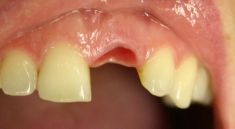 Zubní implantáty - fotka před - Dental Office H33