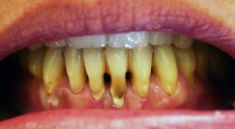 Augmentační techniky v parodontologii a implantologii - fotka před - Dental Office H33