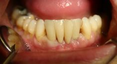 Augmentační techniky v parodontologii a implantologii - fotka před - Dental Office H33