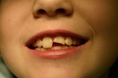 Zubní výplně (záchovná stomatologie) - fotka před - MUDr. Sabina Moravcová