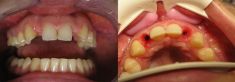 Zubní implantáty - fotka před - MUDr. Radek Pokorný