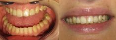Zubní implantáty - fotka před - d´vision - Stomatologické centrum