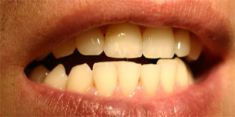 Zubní výplně (záchovná stomatologie) - fotka před - MUDr. Sabina Moravcová