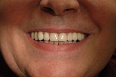 Zubní implantáty - fotka před - MUDr. Sabina Moravcová