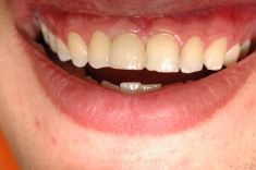 Zubní implantáty - fotka před - MUDr. Sabina Moravcová