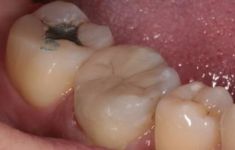 Zubní výplně (záchovná stomatologie) - fotka před - Zubní ordinace Brno - MUDr. Tomáš Sojka - DENTAMEDIKA.cz