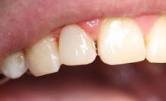 Zubní výplně (záchovná stomatologie) - fotka před - Zubní ordinace Brno - MUDr. Tomáš Sojka - DENTAMEDIKA.cz
