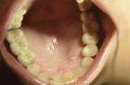Zubní implantáty - fotka před - DesignDent s.r.o.