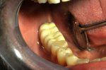 Zubní implantáty - fotka před - DesignDent s.r.o.