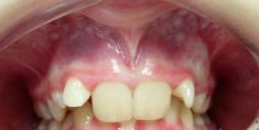 Ortodoncie - fotka před - MUDr. Hana Tycová