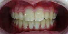 Ortodoncie - fotka před - MUDr. Hana Tycová