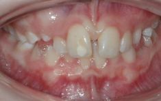 Ortodoncie - fotka před