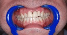 Dentální hygiena - fotka před - Dental Office H33
