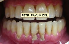 Léčba paradentózy (parodontologie) - fotka před - Dentální hygienista Petr Pavlík DiS.