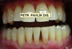 Léčba paradentózy (parodontologie) - fotka před - Dentální hygienista Petr Pavlík DiS.