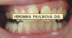 Dentální hygiena - fotka před - Dentální hygienistka Veronika Pavlíková DiS.