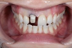 Zubní implantáty - fotka před - THE CLINIC