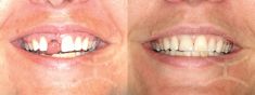 Zubní implantáty - fotka před - Mediestetik, skupina klinik - STOMATOLOGIE