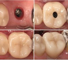 Zubní implantáty - fotka před - Mediestetik, skupina klinik - STOMATOLOGIE