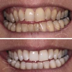 Bělení zubů - fotka před - Mediestetik, skupina klinik - STOMATOLOGIE