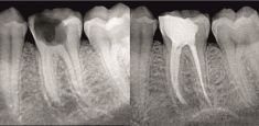 Endodoncie (ošetření kořenových kanálků) - fotka před