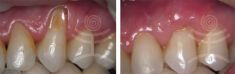 Léčba paradentózy (parodontologie) - fotka před - Mediestetik, skupina klinik - STOMATOLOGIE