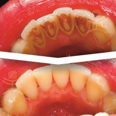Dentální hygiena - fotka před - Mediestetik, skupina klinik - STOMATOLOGIE