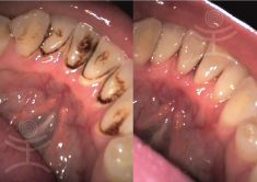 Dentální hygiena - fotka před - Mediestetik, skupina klinik - STOMATOLOGIE