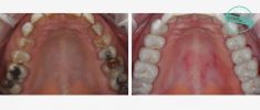 Zubní implantáty - fotka před - Brandeis Clinic by Radoslav Lacina